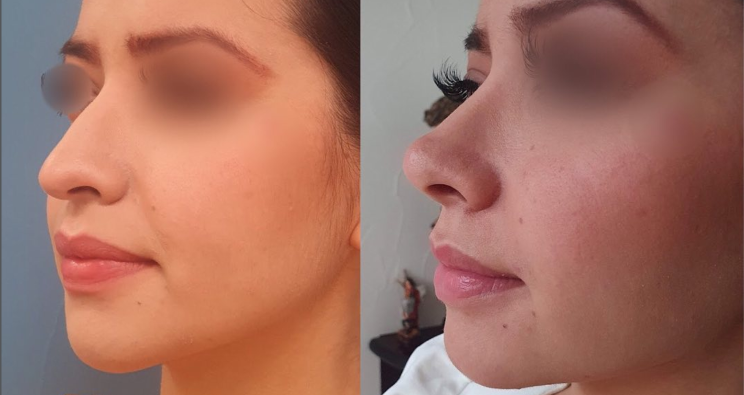 Antes y después de cirugía de nariz